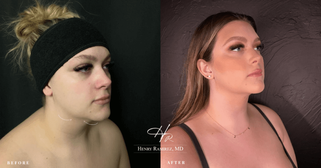 Before After Azure Med Spa Frisco, Texas