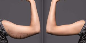 Before-and-after image showing sagging upper arm skin tightened and contoured using BodyTite radiofrequency treatment for firmer results.