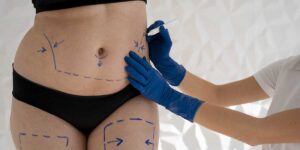 A medical practitioner uses a surgical marker to outline treatment areas on a patient's abdomen and upper thighs before body contouring.