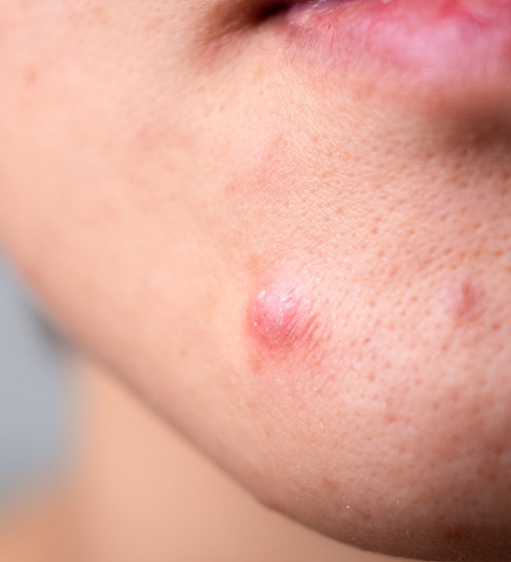 acne and skin problem.