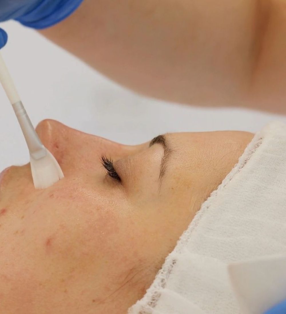 chemical peels cover image